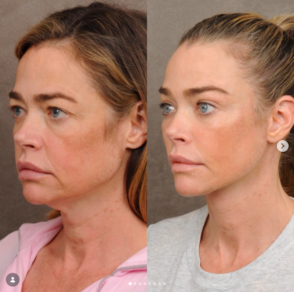 The first comparison presents an extensive transformation without erasing Richards' identity. Her doctor emphasized that the operation was meant to preserve her defining features. | Source: Instagram/drbentalei and deniserichards