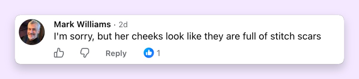 Another observer claimed, "I'm sorry, but her cheeks look like they are full of stitch scars." The speculation carried added sensitivity given Presley's documented history as the victim of unauthorized cosmetic injections. | Source: Facebook/E! News