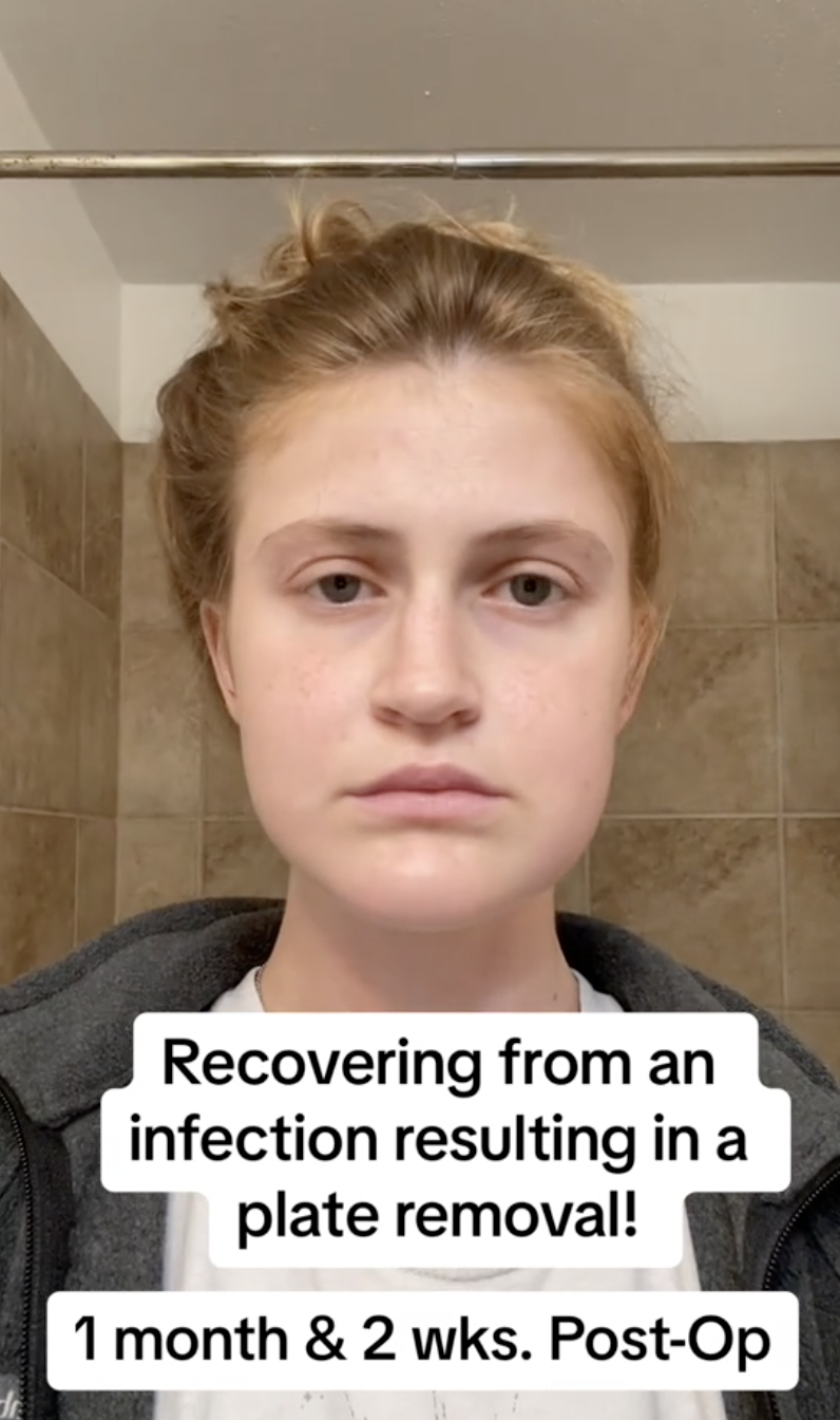Virginia Elder shows a blank expression, documenting the toll of her recovery process. | Source: TikTok/virginiaeelder