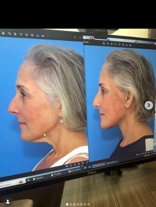 Her newest Instagram carousel celebrates her transformation after having a facelift two years ago. This is a before-and-after comparison as seen on a monitor screen. | Source: Instagram/rickilake