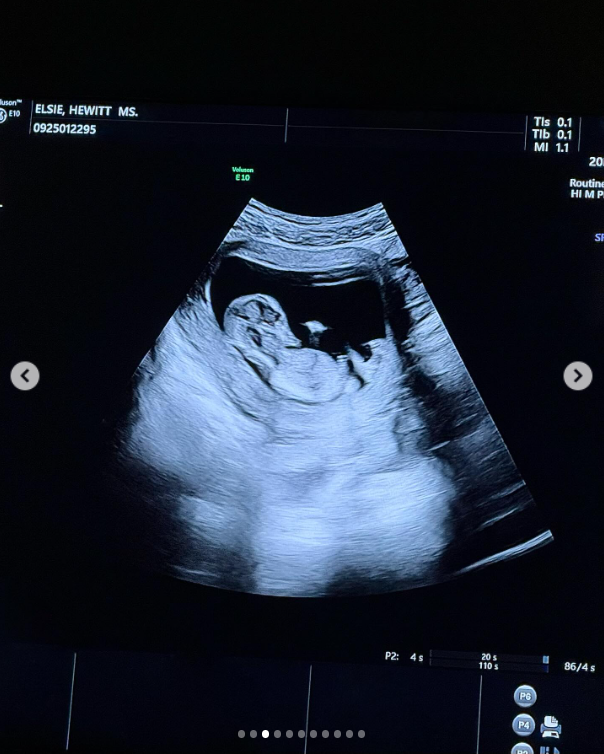 A sonogram showing Pete Davidson and Elsie Hewitt's baby, from a post dated July 16, 2025 | Source: Instagram/elsie