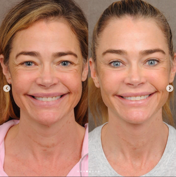 Richards wanted to retain expressions that had been familiar throughout her career. Talei said the internal work helped her smile appear cleaner and more relaxed. | Source: Instagram/drbentalei and deniserichards