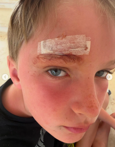 A close-up photo of Leonardo Baldwin's injury. | Source: Instagram/hilariabaldwin and alecbaldwininsta