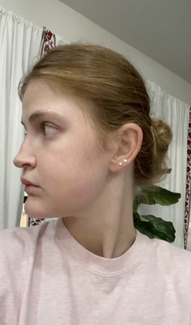 Side angle of Virginia Elder on Day 9 post-op, showing facial symmetry developing. | Source: TikTok/virginiaeelder