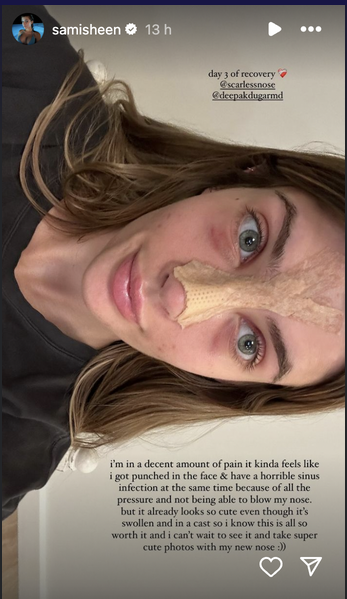 Sami Sheen shares her experience after undergoing a nose job, on her Instagram Stories on August 15, 2024