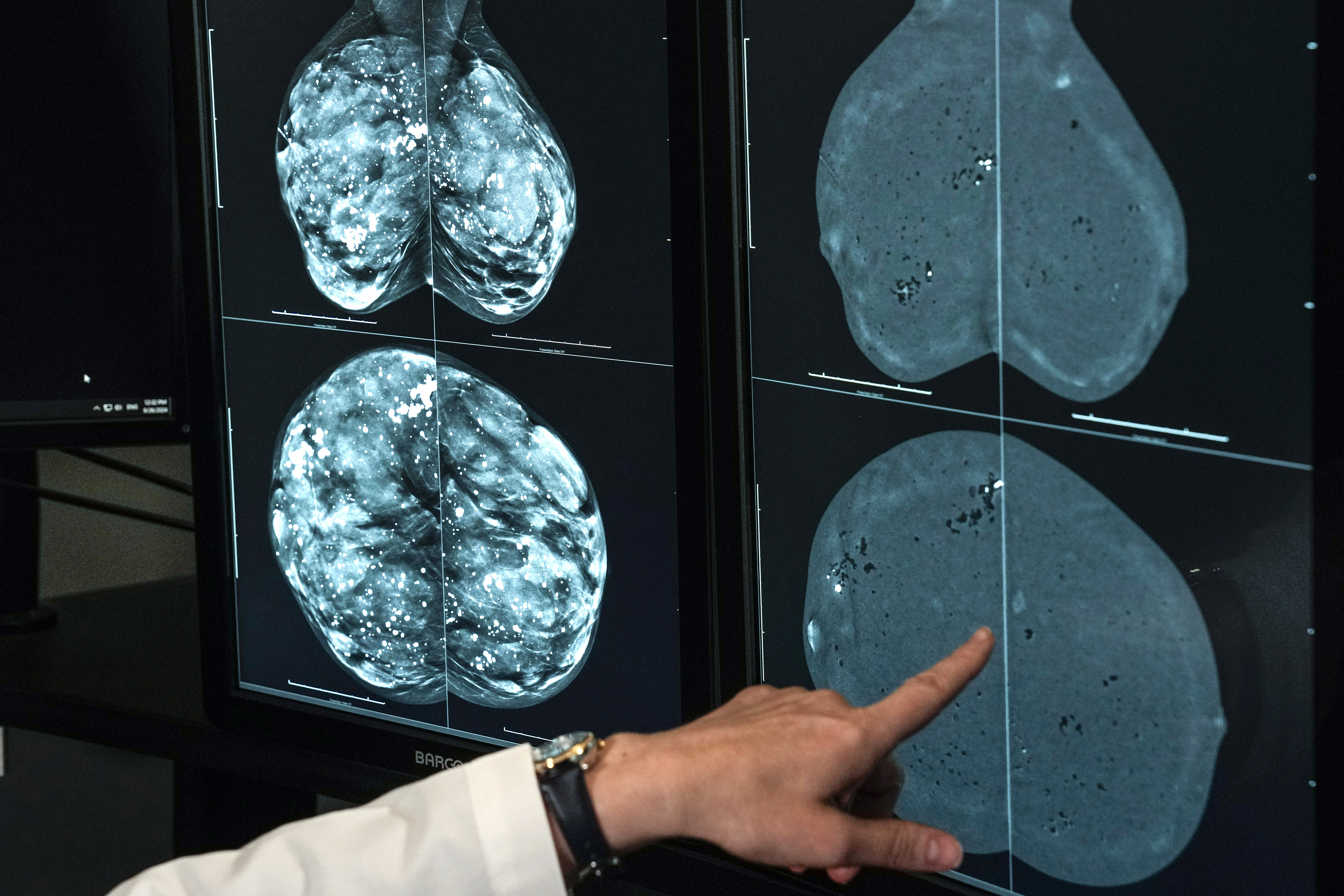 A radiologist reviews mammogram images, which can help detect breast abnormalities before they become noticeable. | Source: Getty Images.