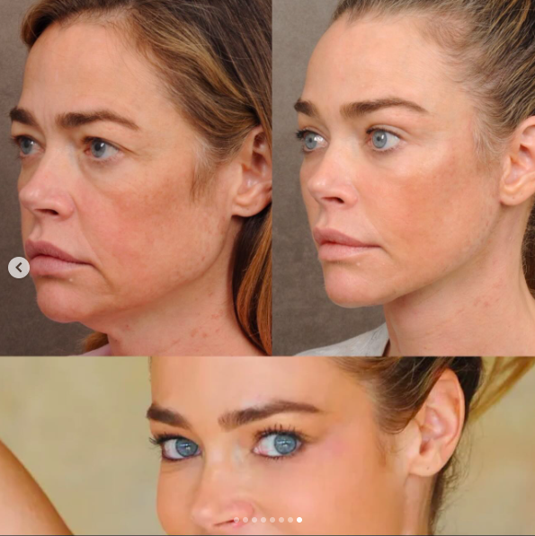 The collage visually links Richards' post-surgery face with the appearance audiences remember from her earlier career. Her stated goal was to recover familiar qualities rather than chase an entirely new identity. | Source: Instagram/drbentalei and deniserichards