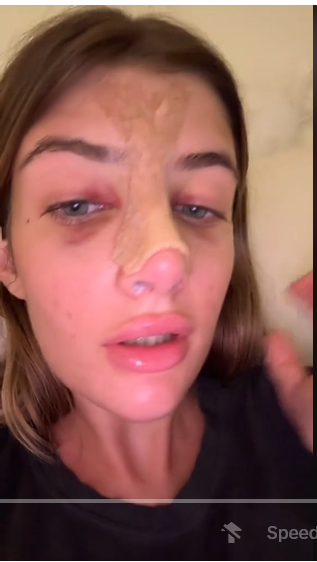 Sami Sheen shares her experience taking care of her nose post-surgery, on a TikTok post dated August 15, 2024
