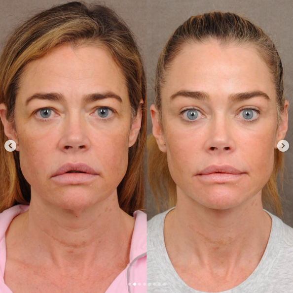 The frontal images highlight coordinated changes around the brows, eyes, mouth, jawline, and neck. Richards later called the difference "night and day." | Source: Instagram/drbentalei and deniserichards