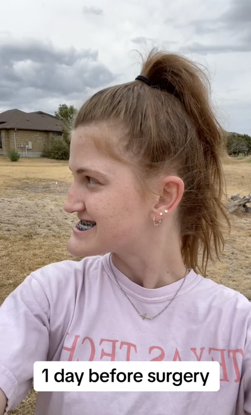 Side profile of Virginia Elder one day before surgery, showing her jaw's natural alignment. | Source: TikTok/virginiaeelder