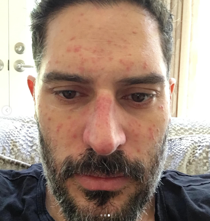 Joe Manganiello shares a close-up photo showing redness and irritated patches across his forehead, cheeks, and nose. The actor said the skin problems were among the symptoms he experienced during his seven-year health battle. | Source: Instagram/joemanganiello