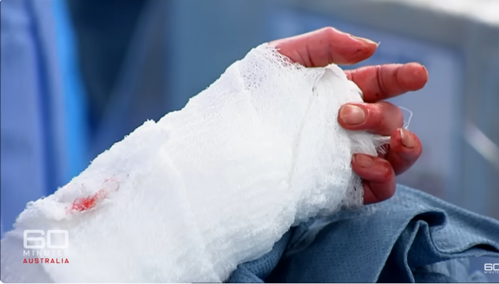 Charla Nash's newly reattached donor hand that became septic, dated June 11, 2025 | Source: YouTube/60MinutesAustralia