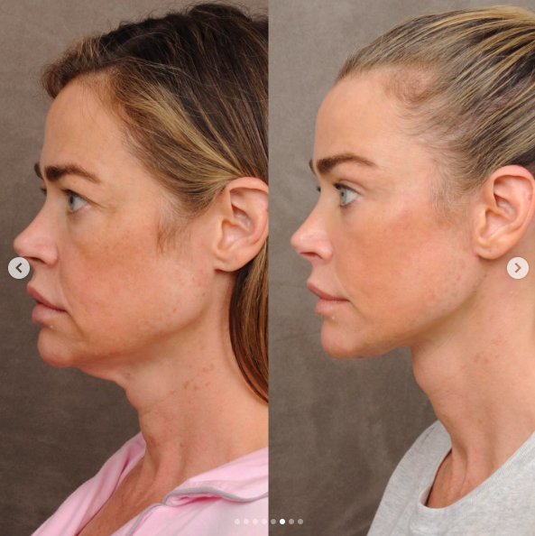 The neck concern that began Richards' surgical journey became part of a broader facial restoration. She later described the decision as one of the best things she had done for herself. | Source: Instagram/drbentalei and deniserichards
