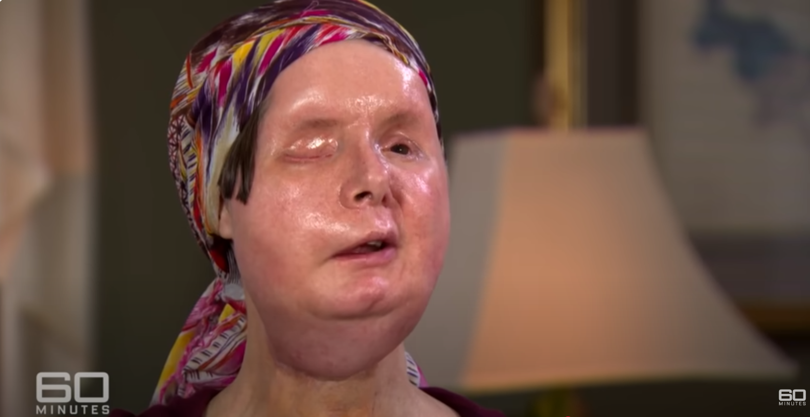 Charla Nash after the gruesome attack by Sandra Herold's pet Chimpanzee, dated June 11, 2025 | Source: YouTube/60MinutesAustralia