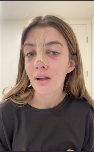 Sami Sheen shares her experience getting a nose job done, on a TikTok post dated August 13, 2024