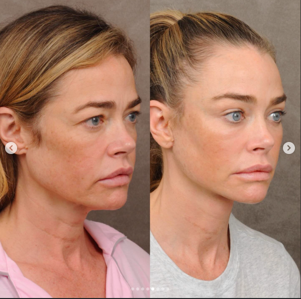 The angled view shows how numerous small adjustments combined into one result. Richards said the full difference became most apparent when she revisited her earlier photographs. | Source: Instagram/drbentalei and deniserichards