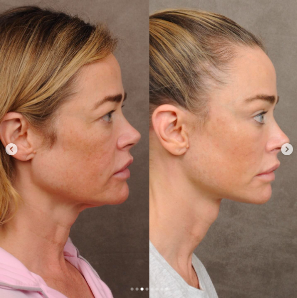 Richards initially wanted to address only her neck. The profile demonstrates why her surgeon believed facial balance required treating more than one isolated area. | Source: Instagram/drbentalei and deniserichards