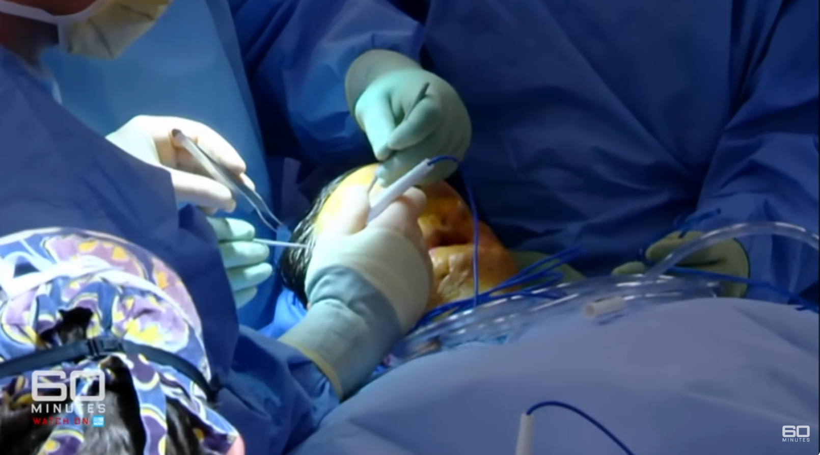 A team of surgeons working on Charla Nash during face transplant surgery, dated June 11, 2025 | Source: YouTube/60MinutesAustralia