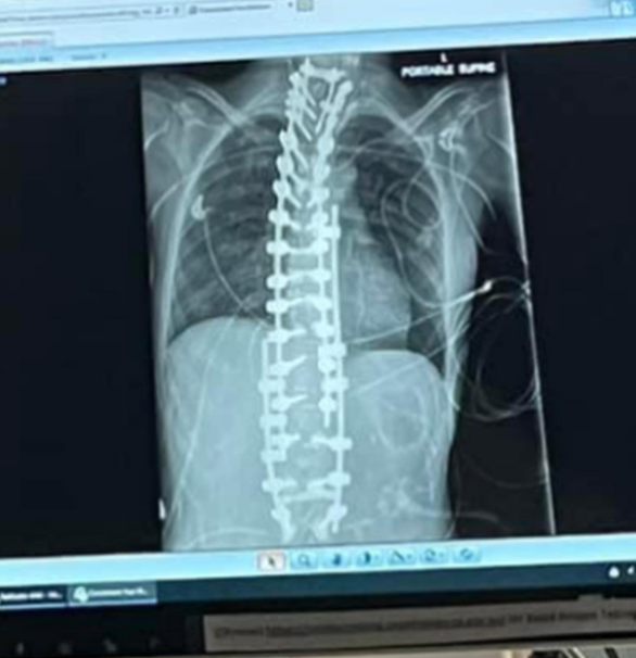 An x-ray of Annaliese "Annie" Holland's spine, from a post dated September 27, 2023 | Source: Instagram/annaliese_holland