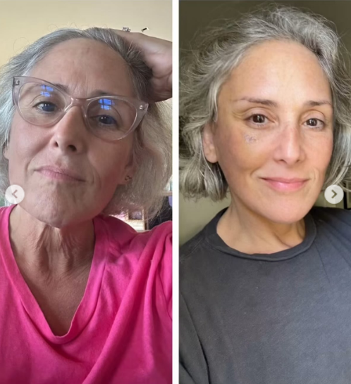 In another side-by-side comparison, not only does her jawline look better, but her entire facial skin looks much better. | Source: Instagram/rickilake