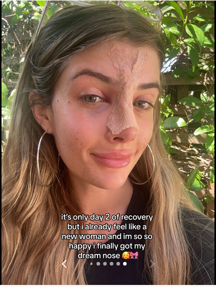 Sami Sheen shares her experience getting a nose job done, on a TikTok post dated August 13, 2024