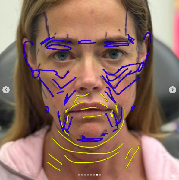 Richards said the markings initially made her think, "Oh my gosh." Seeing the detailed map showed her just how comprehensive the surgery would be. | Source: Instagram/drbentalei and deniserichards